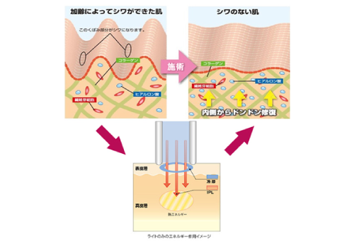 加齢によってシワができた肌