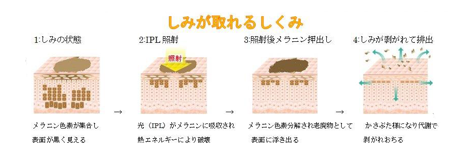 フォトＲＦ，Ｅライト