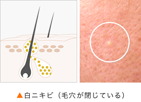 白ニキビ