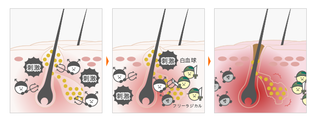 ニキビの改善やニキビが出来にくい肌作りのカギは 「ビタミンA」ビタミンAのニキビに対する働き