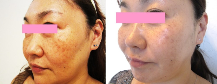 しみ、くすみの改善