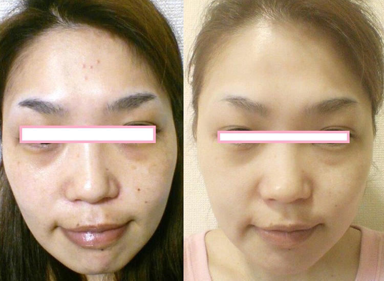 エンビロントリートメントとフォトRFの混合治療