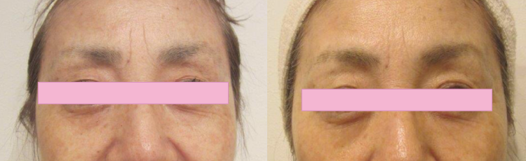 エンビロントリートメントとフォトRFの混合治療