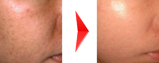 エンビロントリートメントとフォトRFの混合治療