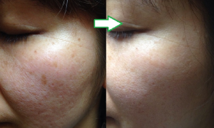 フォトフェイシャルコース