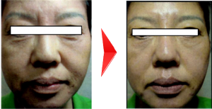 フォトRF＋エイジングケア＋コラーゲン活性